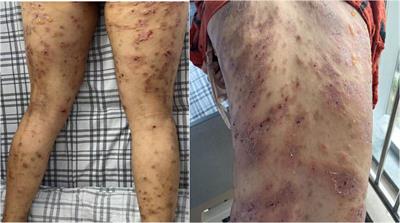 Case report: Bullous pemphigoid combined with Sjögren’s syndrome complicated by central nervous system infection